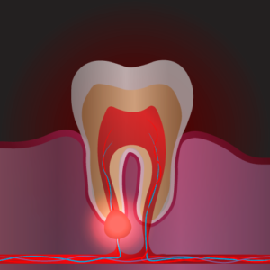 cura e cause ascesso dentale