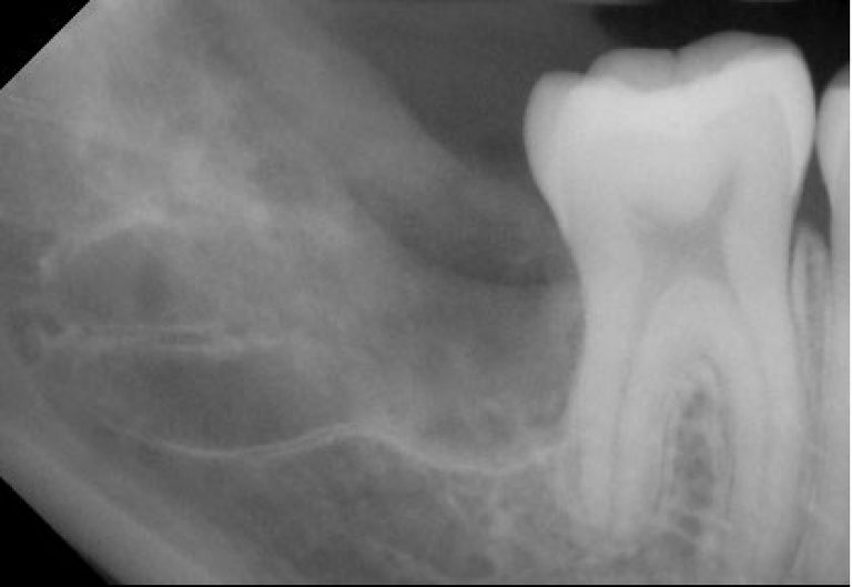 Denti-del-Giudizio_dentegiudizio-radio2c_03-768x529