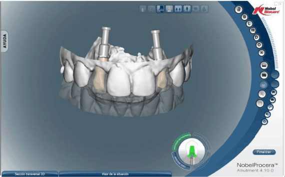 Implantologia dentale progettazione