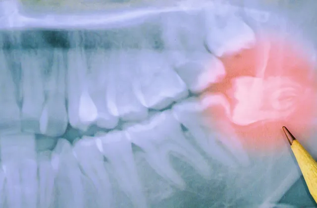 rimuovere Denti del giudizio