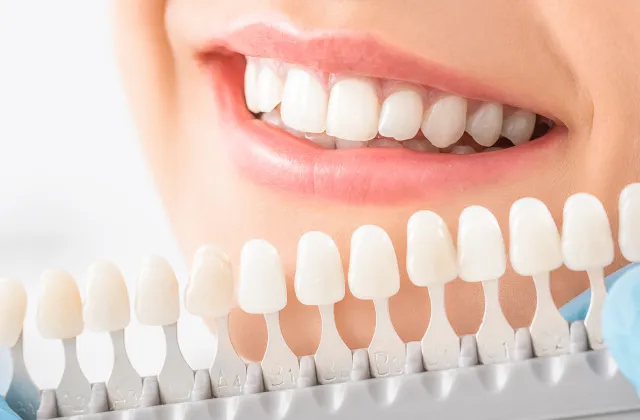 Cosa sono le faccette dentali