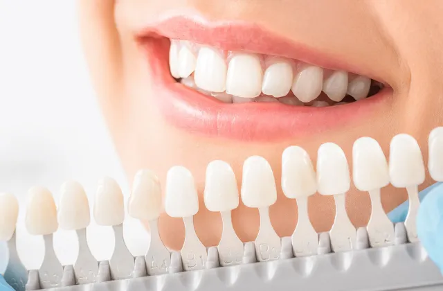 sbiancamento dentale
