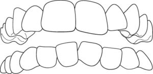 malocclusione affollamento dentale