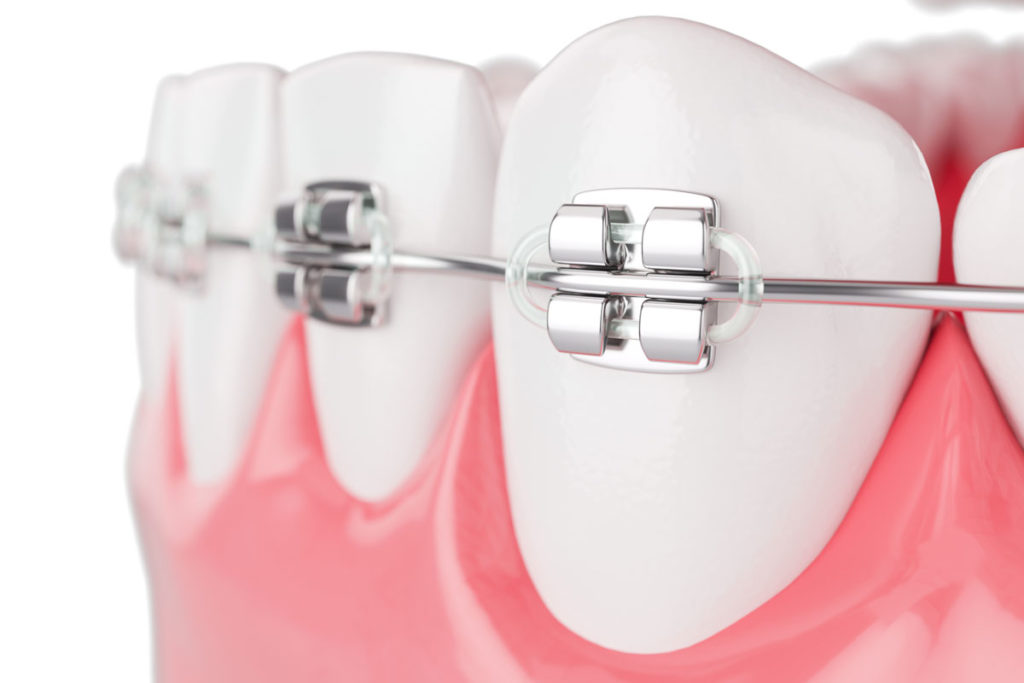 apparecchio per i denti con brackets