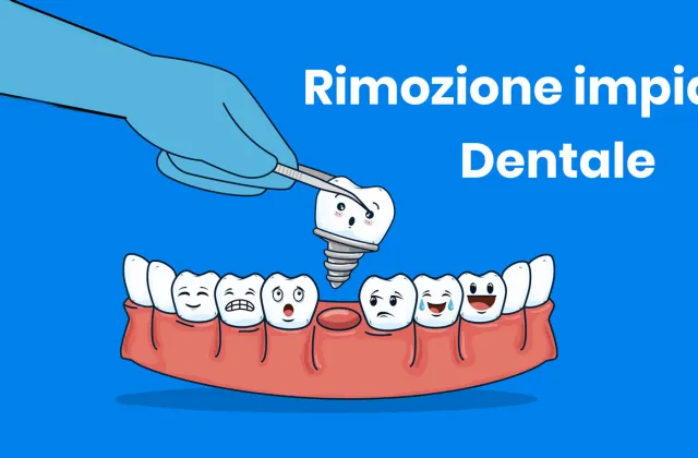 Rimuovere un impianto dentale: quando, come e perché farlo (e sostituirlo)