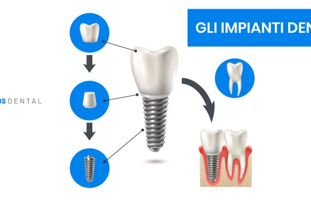 fisionomia di un impianto dentale