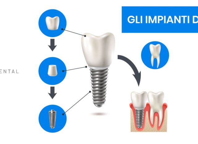 fisionomia di un impianto dentale