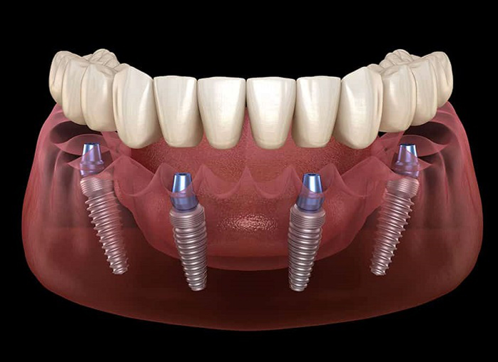 impianti dentali all in 4