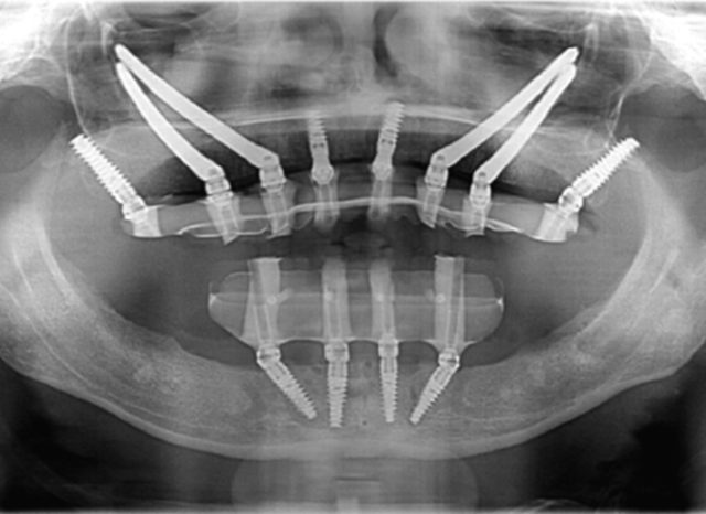 impianti dentali senza osso
