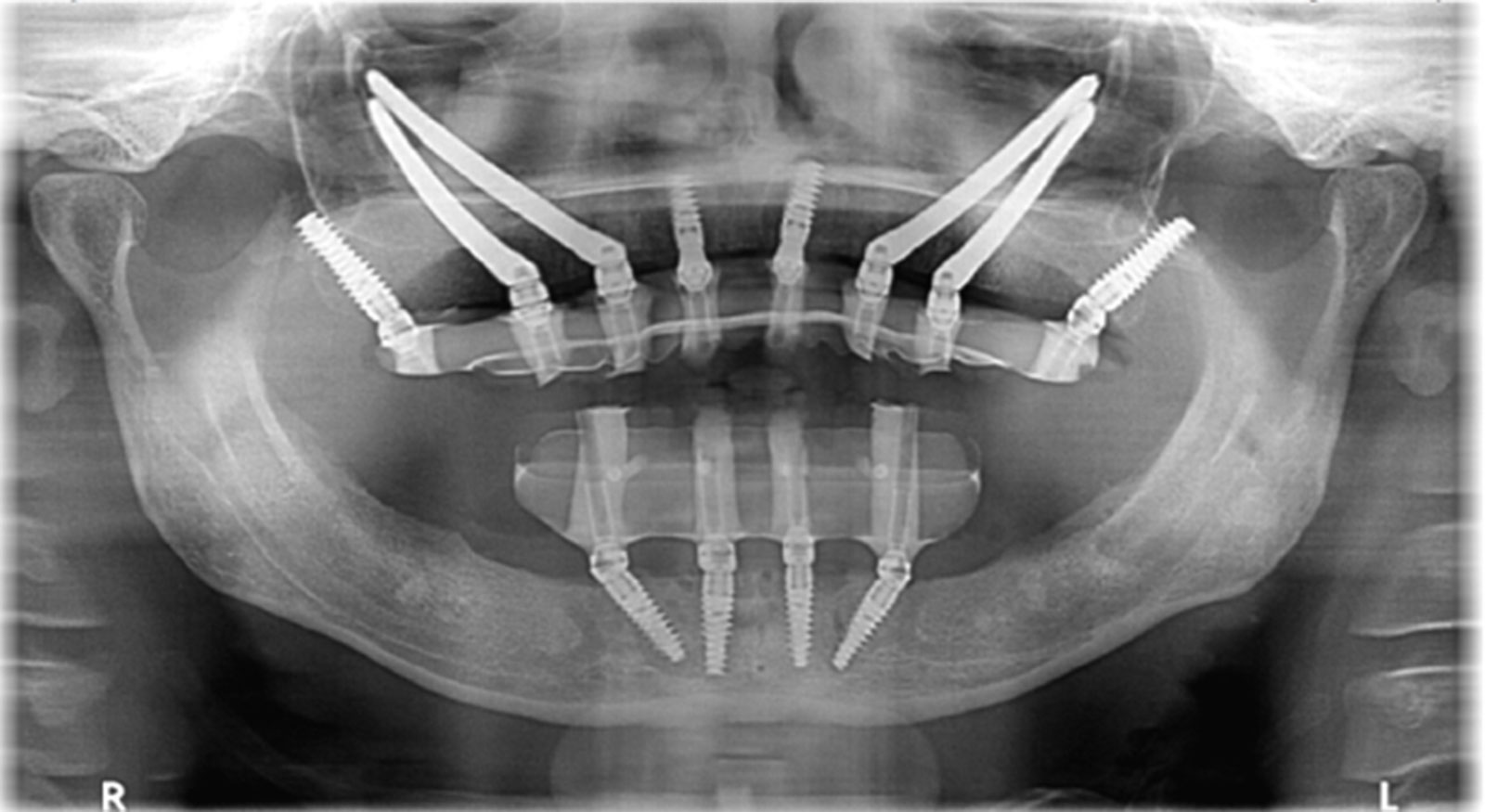 Impianto Dentale E Implantologia La Guida Definitiva Dalla A Alla Z Impianto Dentale E Implantologia La Guida Definitiva Dalla A Alla Z