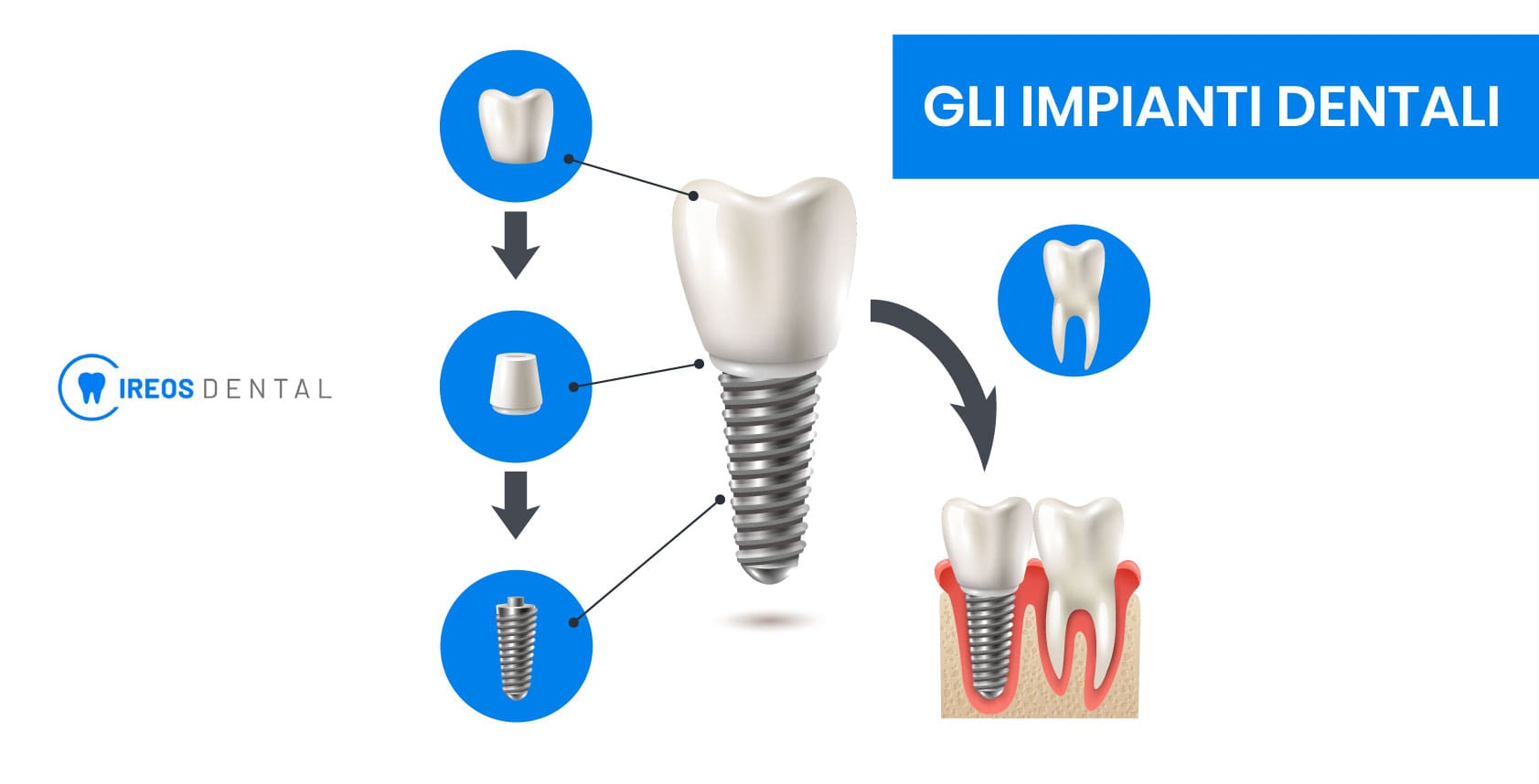 fisionomia di un impianto dentale