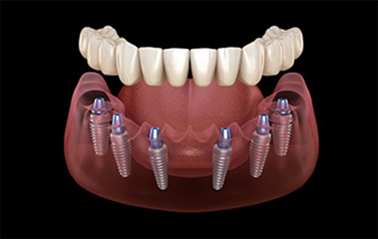 impianto dentale all in 6