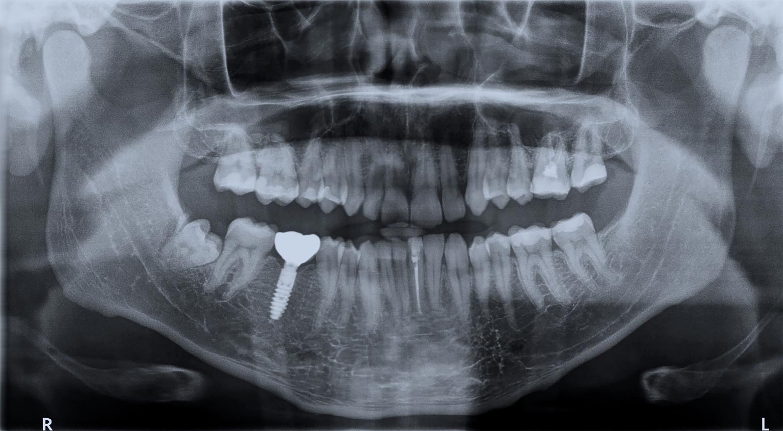 radiografia panoramica di un impianto dentale