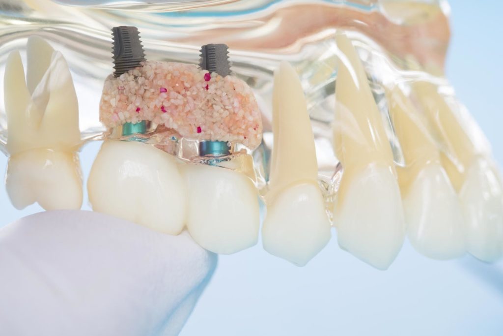 Impianto Dentale E Implantologia La Guida Definitiva Dalla A Alla Z Impianto Dentale E Implantologia La Guida Definitiva Dalla A Alla Z