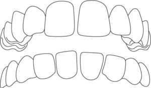 malocclusione spazio tra i denti