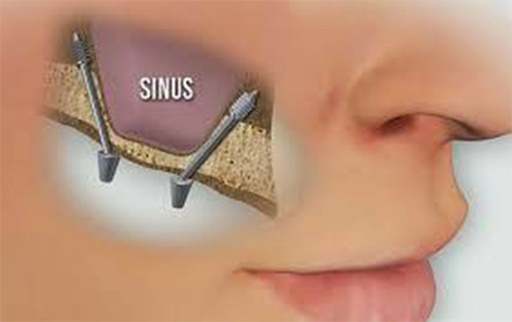 tecnica implantologica sinus lift