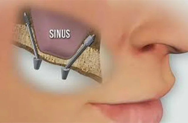 tecnica implantologica sinus lift