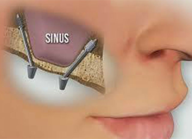 tecnica implantologica sinus lift