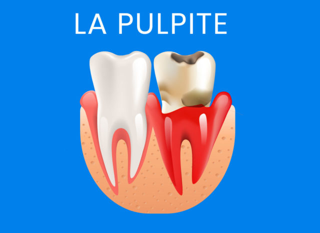 la pulpite