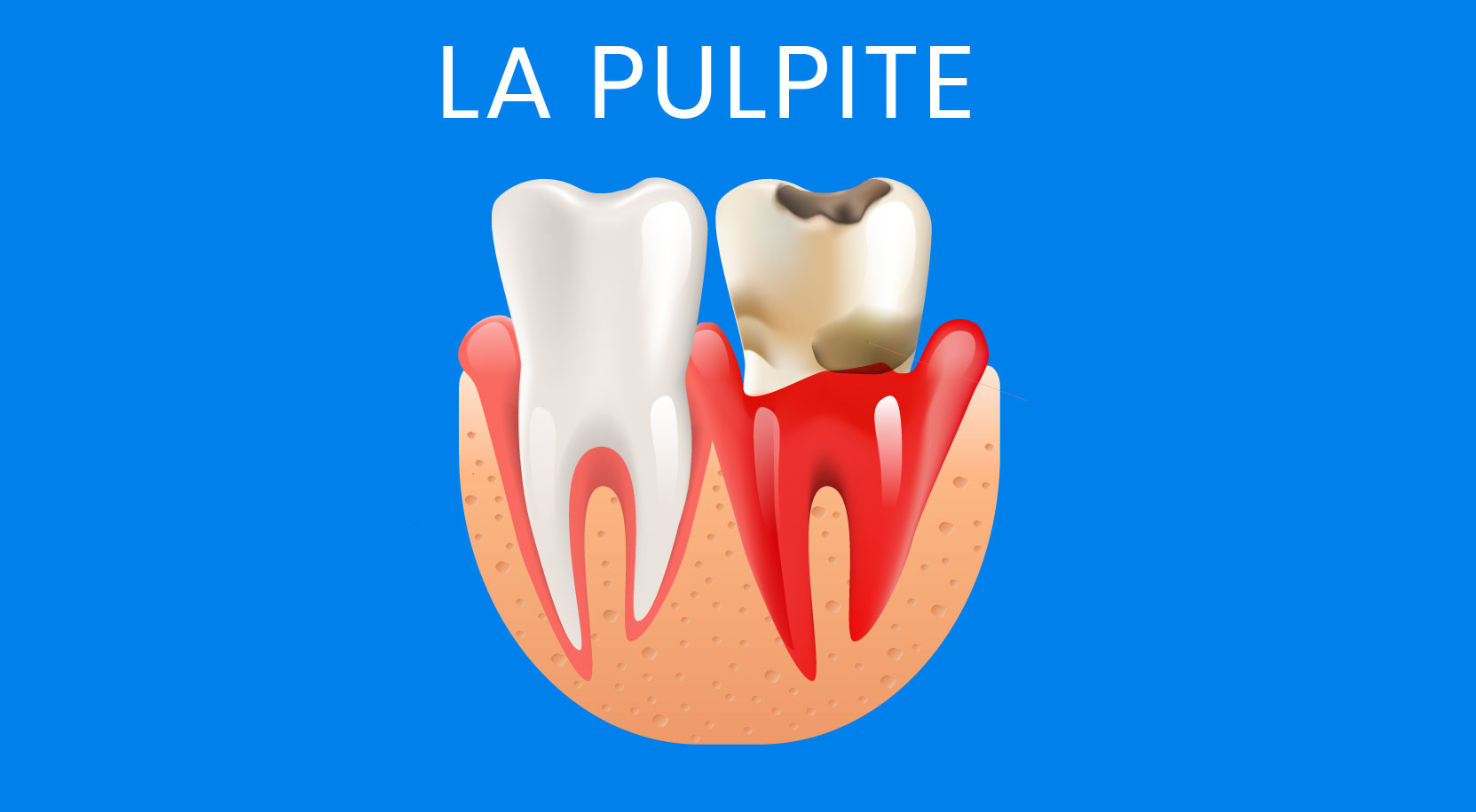 la pulpite