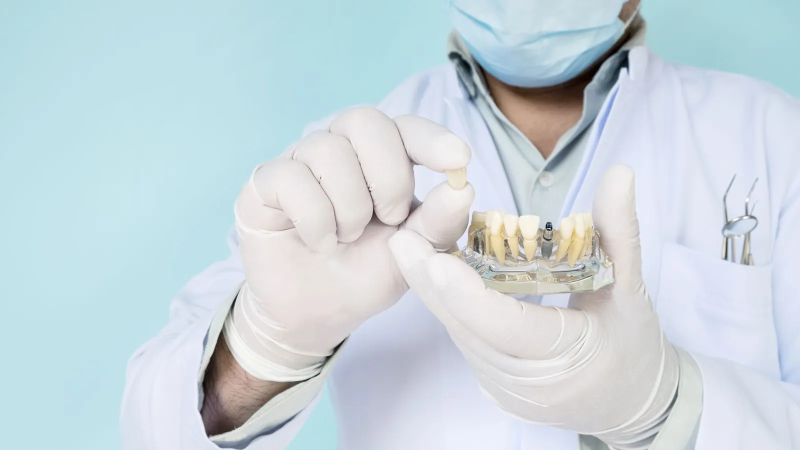 perimplantite