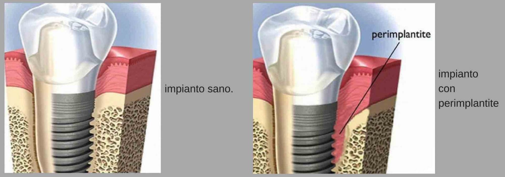 perimplantite impianto dentale 