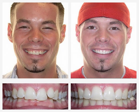 apparecchi-invisalign-prima-dopo