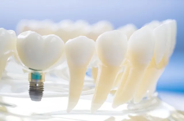 impianti dentali a basso costo in Italia