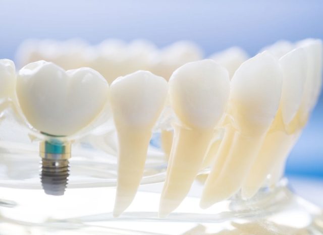 impianti dentali a basso costo in Italia