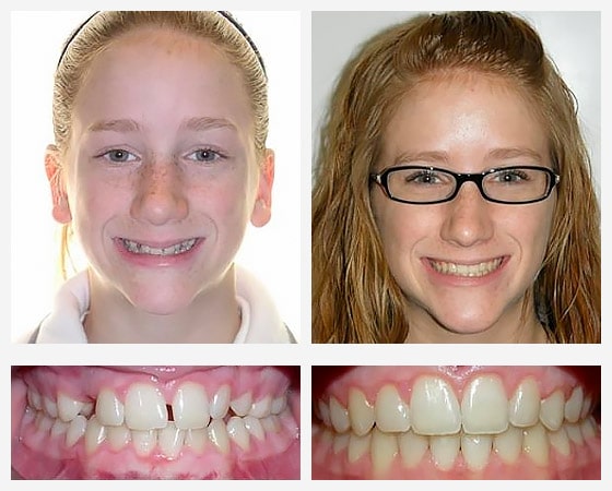 invisalign mascherine