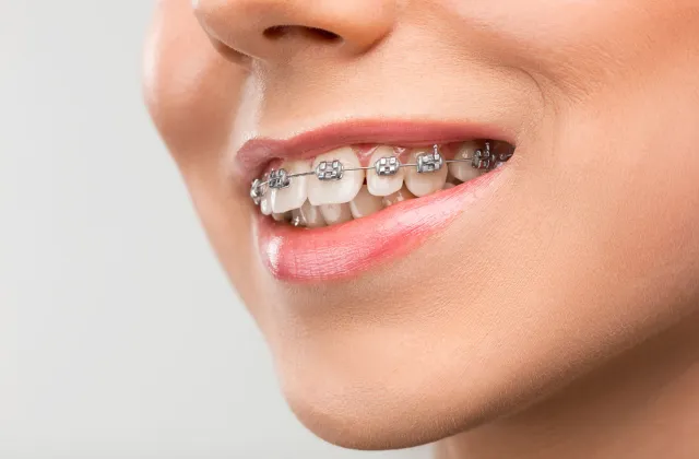 malocclusione dentale
