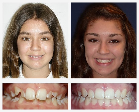 risultato invisalign