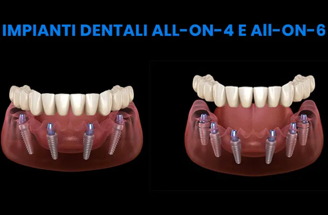 impianti dentali all-on-4 e impianti dentali all-on-6