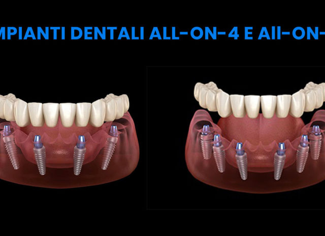 impianti dentali all-on-4 e impianti dentali all-on-6