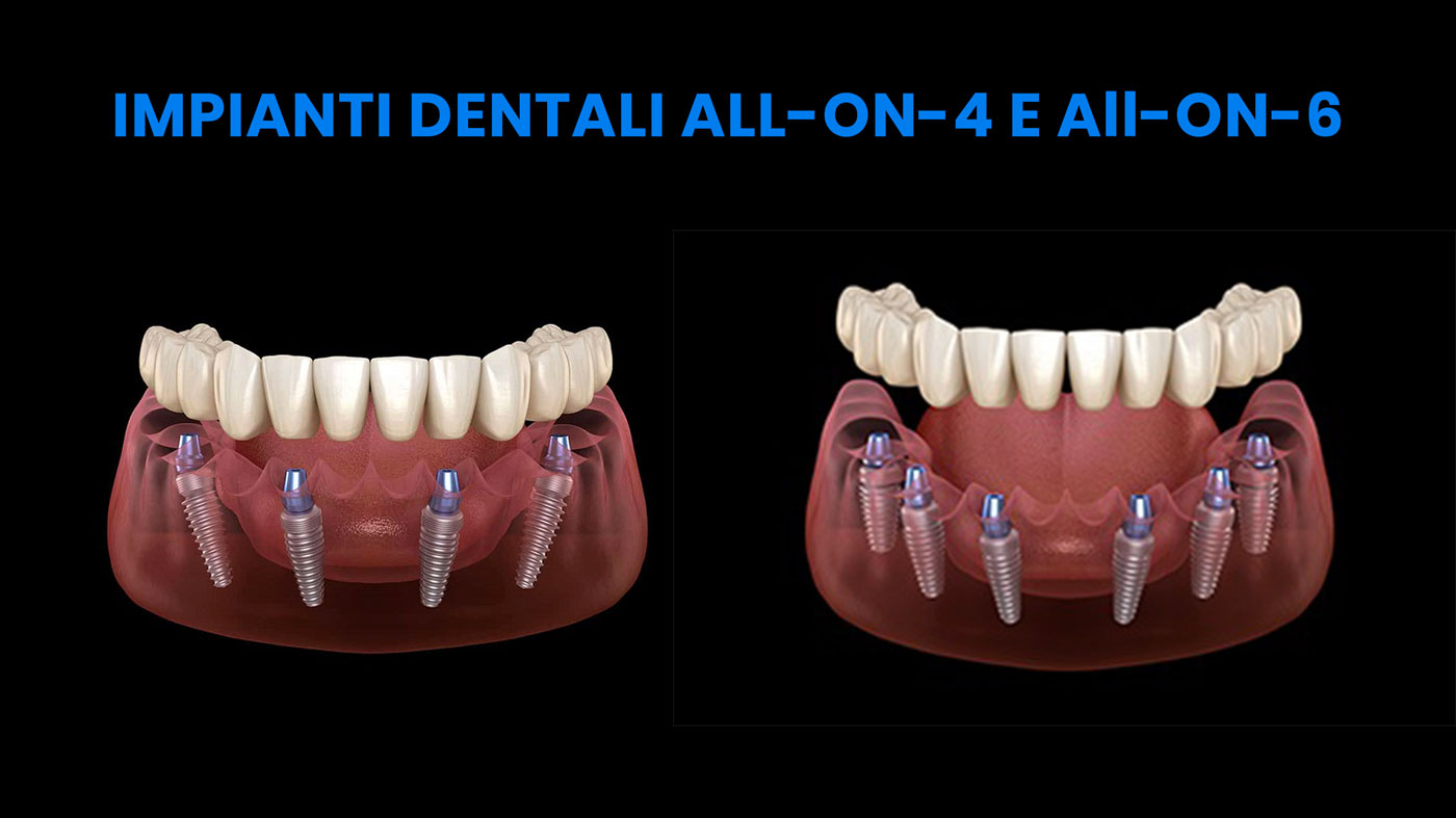 impianti dentali all-on-4 e impianti dentali all-on-6