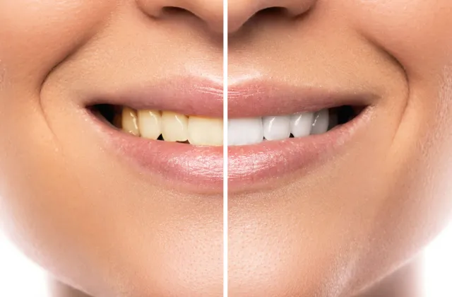 come avere i denti bianchi