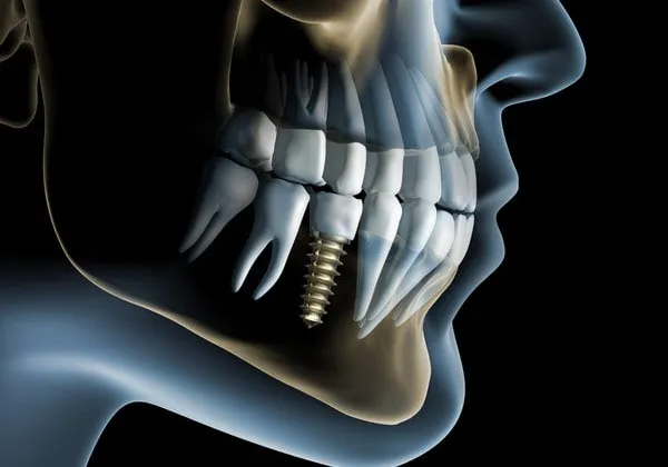 quanto costa un impianto dentale