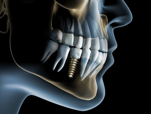 quanto costa un impianto dentale