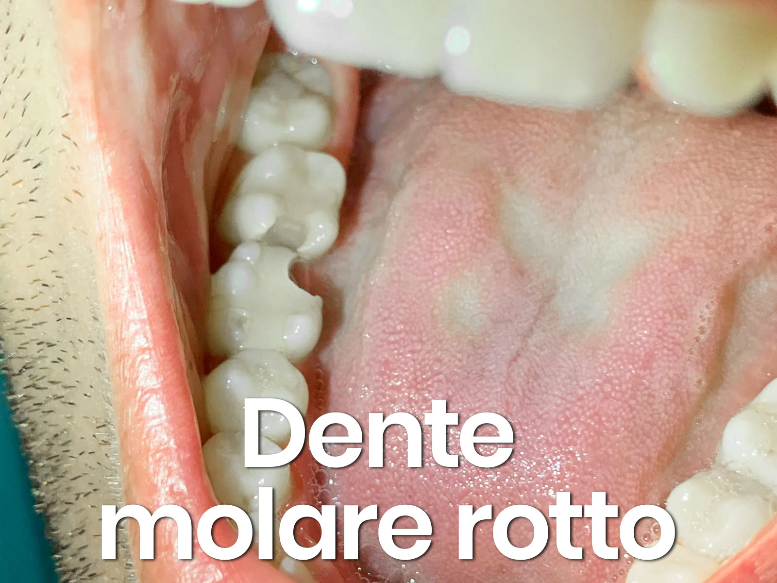 dente molare spezzato