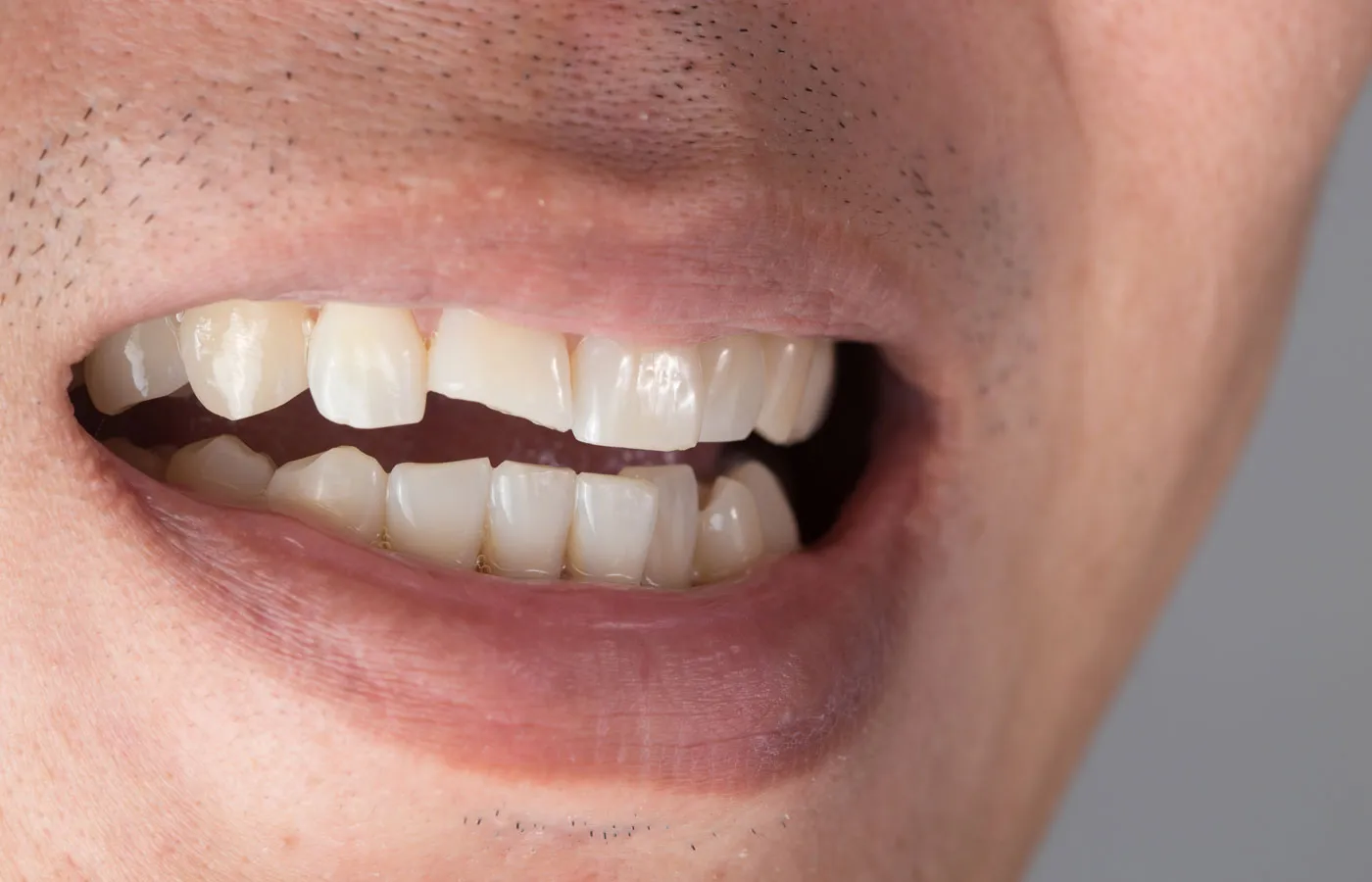 ricostruire un dente spezzato