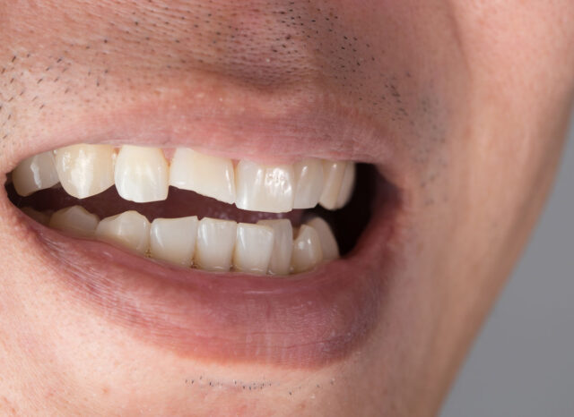 ricostruire un dente spezzato