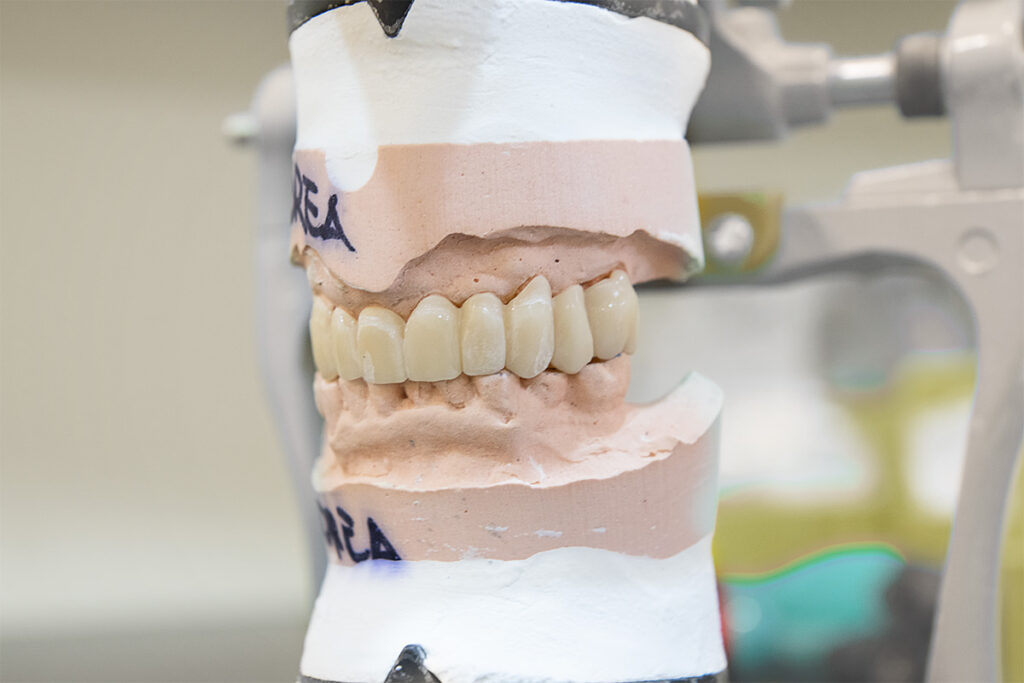 denti fissi in 24h meno di un giorno