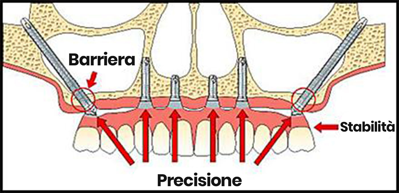 raffigurazione impianti dentali zigomatici