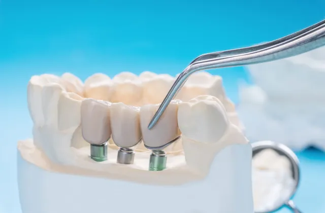 corona dentale su impianto