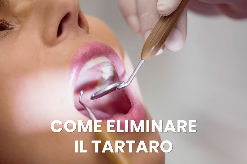 come eliminare il tartaro