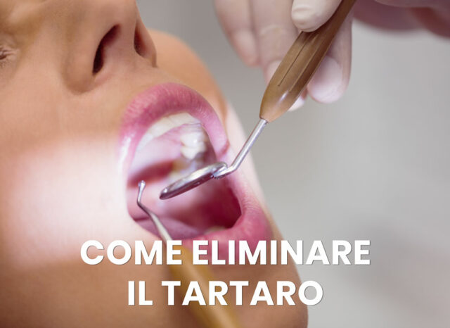 come eliminare il tartaro