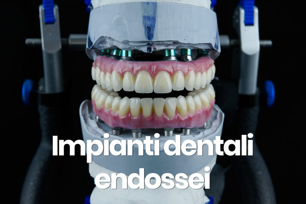 impianti dentali endossei