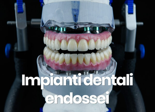 impianti dentali endossei