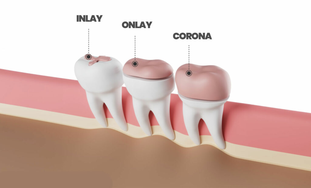 intarsio e corona dentale