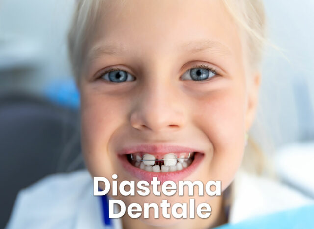 diastema dentale